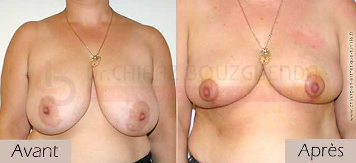 photos-avant-apres-patient5-reduction-seins-en-tunisie