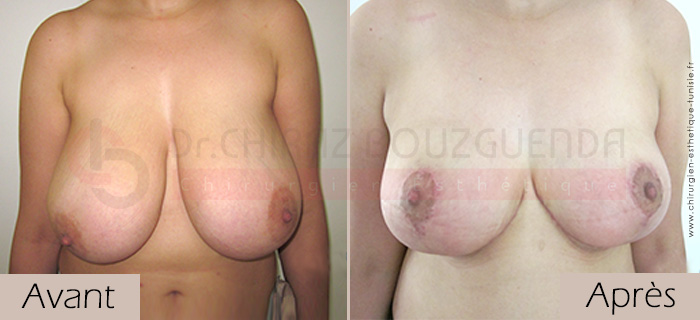 photos-avant-apres-patient6-reduction-seins-en-tunisie