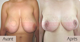 photos-avant-apres-patient6-reduction-seins-en-tunisie