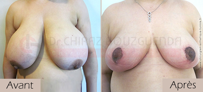 photos-avant-apres-patient7-reduction-seins-en-tunisie