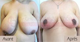 photos-avant-apres-patient7-reduction-seins-en-tunisie