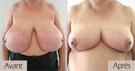 photos-avant-apres-patient8-reduction-seins-en-tunisie