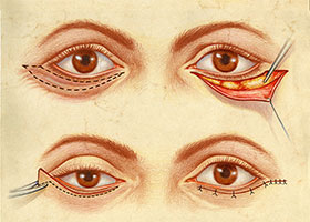 /blepharoplastie-inferieure