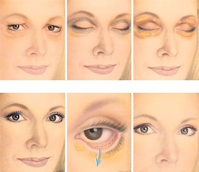 blepharoplastie-tunisie