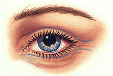 cicatrices-blepharoplastie-tunisie