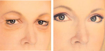 resultat-blepharoplastie-tunisie