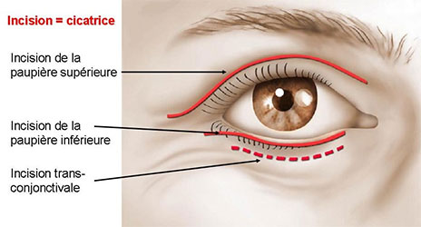 techniques-blepharoplastie-tunisie