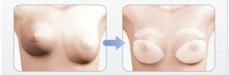 changement implant mammaire tunisie