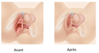 vaginoplastie-tunisie