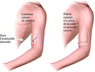 correction-cicatrices-tunisie