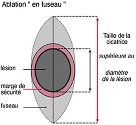 excision-simple-cicatrice