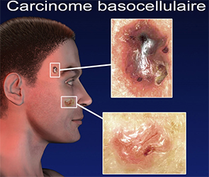 dermatologie-chirurgicale-tunisie