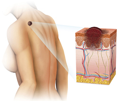 chirurgie-dermatologique-tunisie