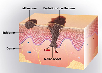 evolution-melanomes