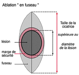 dermato-tumeur-cutanee