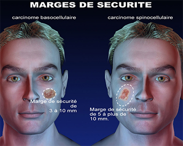 dermato-tumeurs-cutanees