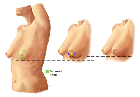 lifting seins tunisie