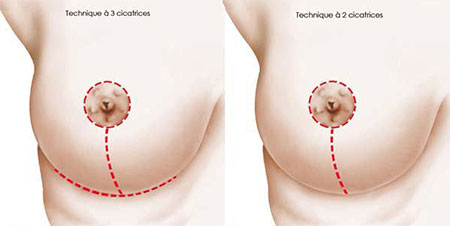 cicatrices-reduction-mammaire-tunisie