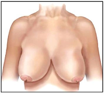 hypertrophie mammaire tunisie 