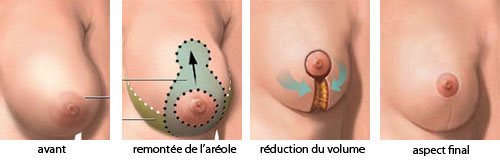 plastie mammaire reduction tunisie