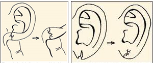chirurgie-esthetique-lobes-oreilles-tunisie