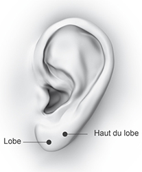 chirurgie-lobes-oreilles-tunisie