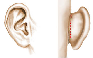 cicatrices-otoplastie-tunisie