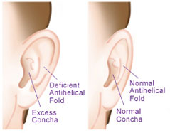 oreille-decollee-defaut-plicature-anthelix