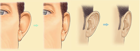 chirurgie-oreilles-decollees-tunisie