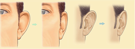 chirurgie-oreilles-decollees-tunisie