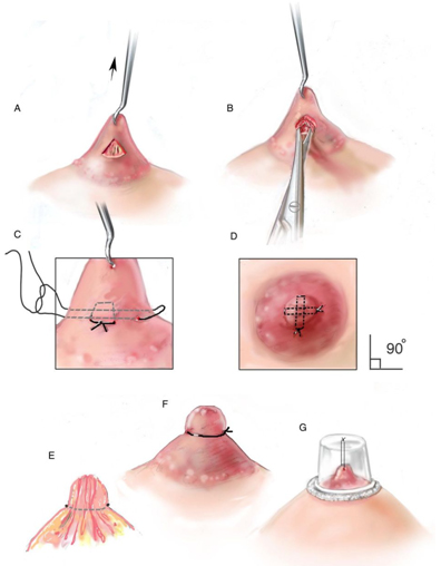 chirurgie mamelons invagines tunisie