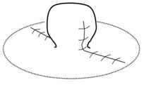 cicatrices chirurgie mamelons ombiliques tunisie