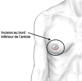 chirurgie gynecomastie homme tunisie