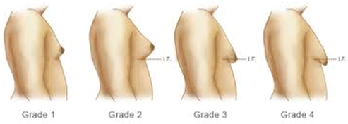 classification gynecomastie tunisie