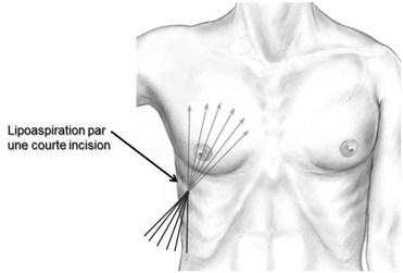 gynecomastie traitee par liposuccion tunisie