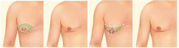 gynecomastie tunisie