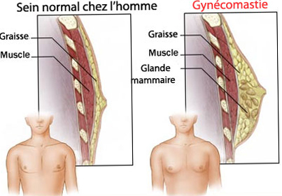 hypertrophie mammaire homme tunisie