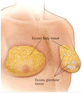 types gynecomastie tunisie