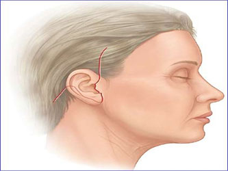 cicatrices-apres-lifting-cervico-facial