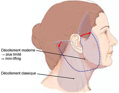 decollement-lifting-cervico-facial-tunisie