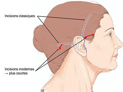 incisions-lifting-cervico-facial-tunisie