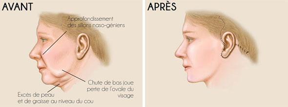 lifting-cervico-facial-tunisie-avant-apres