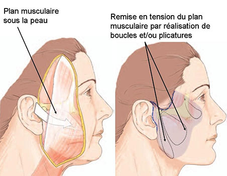 remise-en-tension-lifting-cervico-facial