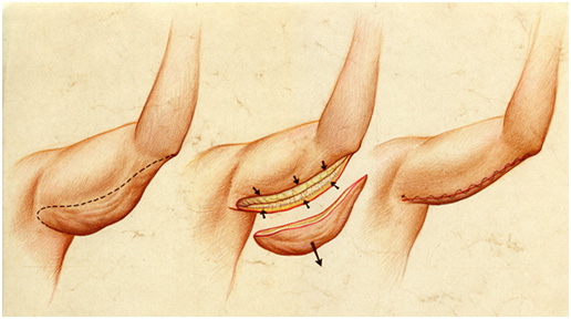 chirurgie esthetique bras tunisie