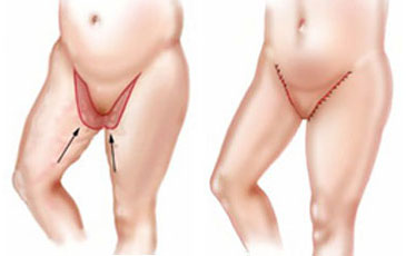 chirurgie esthetique cuisses tunisie