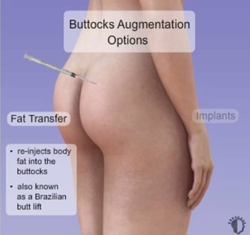 avantages-augmentation-fesses-par-lipofilling-tunisie