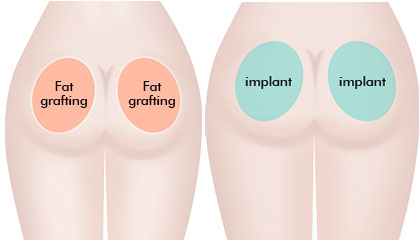 inconvenients--augmentation-fesses-par-lipofilling-tunisie