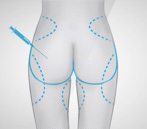 augmentation-fesses-par-lipofilling-tunisie