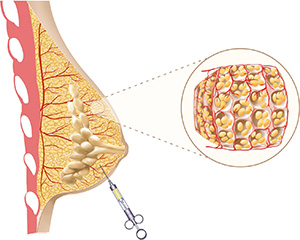 augmentation-seins-par-lipofilling-tunisie