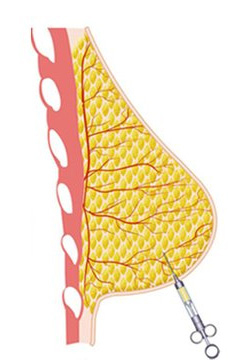 augmentation-mammaire-par-lipofilling-tunisie